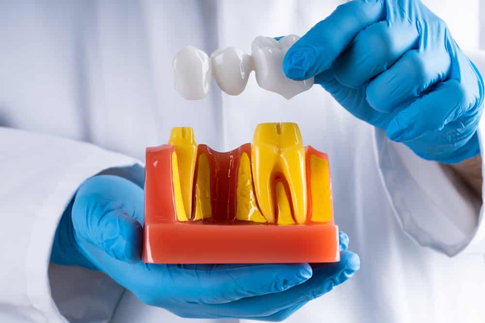 How long do dental bridges last