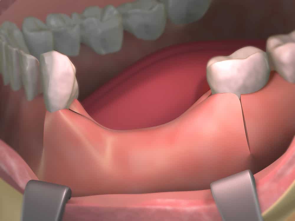 what is bone loss in teeth and how to treat it