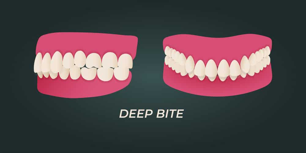 deep bite