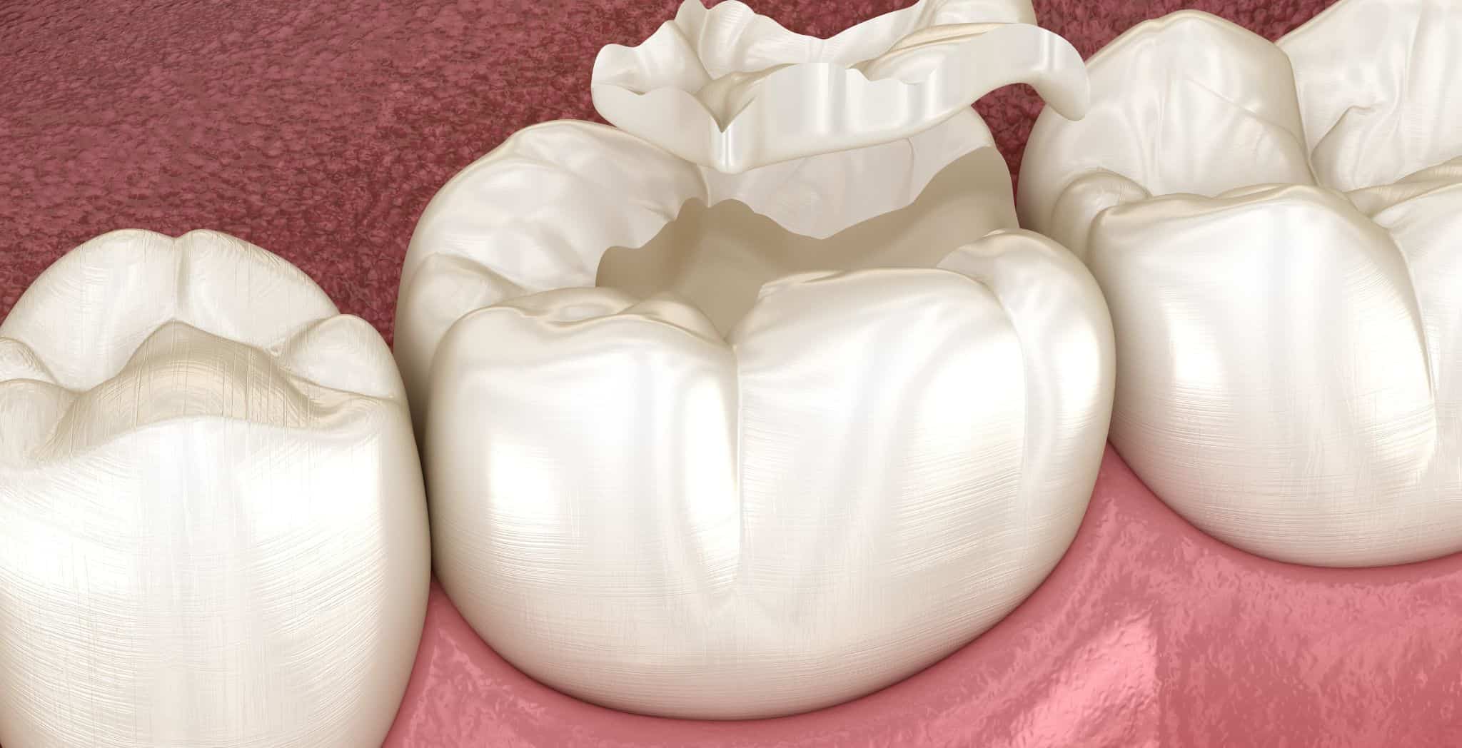 dental sealants for children, children's dental sealants, sealant application for kids, cavity prevention for children, pediatric dental sealants, protecting children's teeth, dental sealants benefits