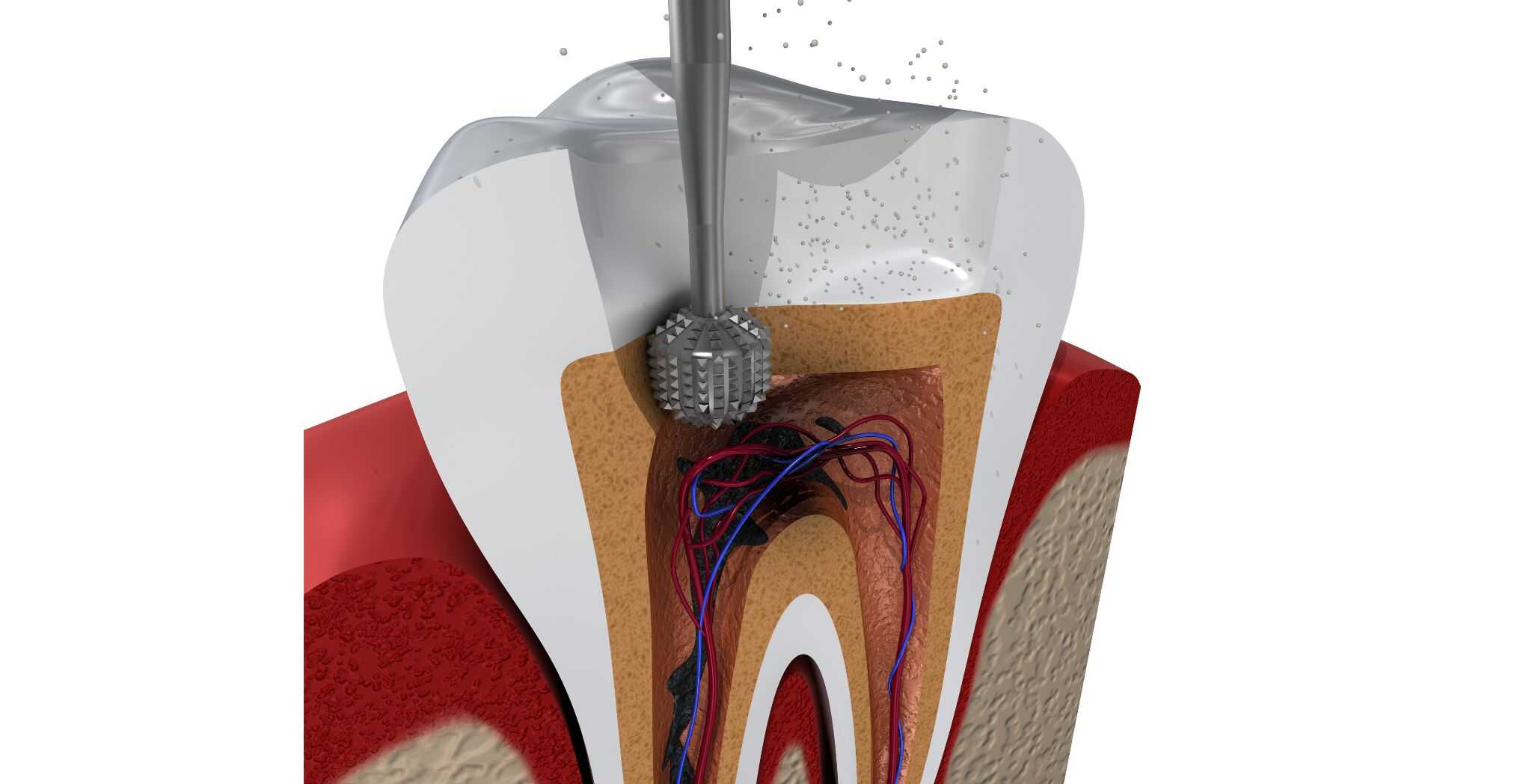 Root canal recovery, Post-root canal care, Healing after root canal, Root canal recovery tips, Tooth pain after root canal, Root canal healing process, Aftercare for root canal